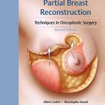 Partial Breast Reconstruction Techniques in Oncoplastic Surgery 2nd Edition